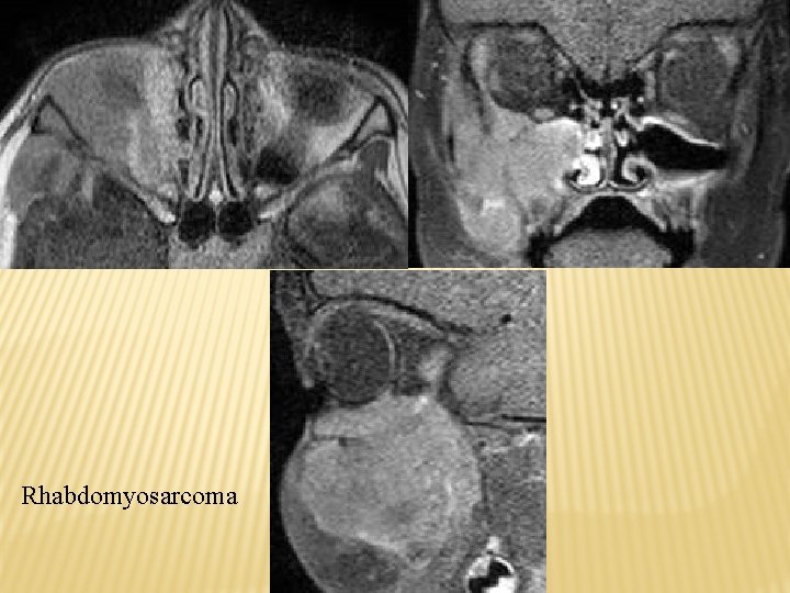 Rhabdomyosarcoma 