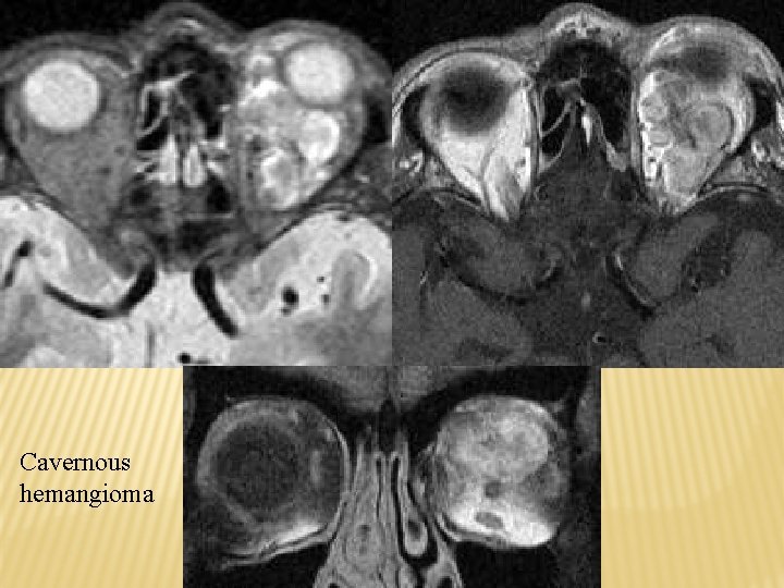 Cavernous hemangioma 