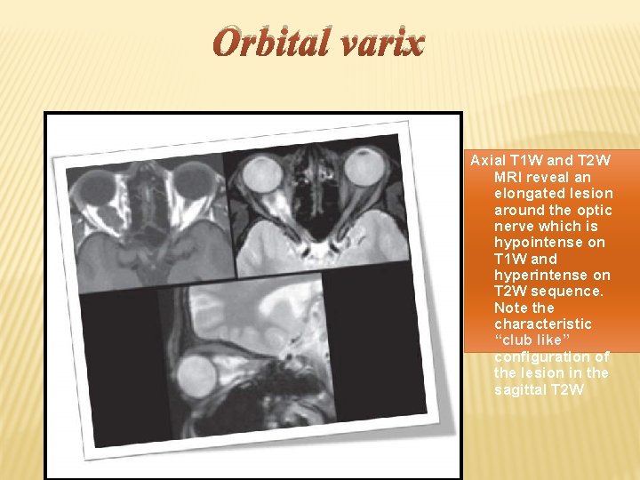 Orbital varix Axial T 1 W and T 2 W MRI reveal an elongated
