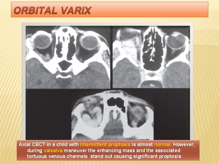 ORBITAL VARIX Axial CECT in a child with intermittent proptosis is almost normal. However,