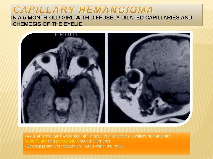 IN A 5 -MONTH-OLD GIRL WITH DIFFUSELY DILATED CAPILLARIES AND CHEMOSIS OF THE EYELID