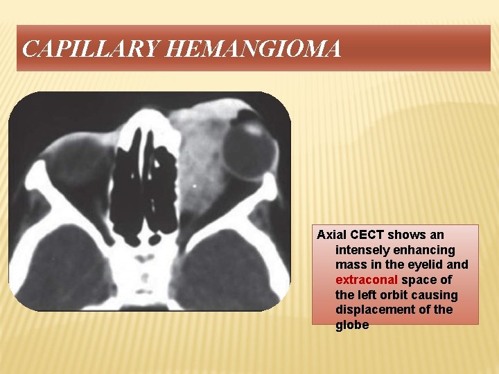 CAPILLARY HEMANGIOMA Axial CECT shows an intensely enhancing mass in the eyelid and extraconal