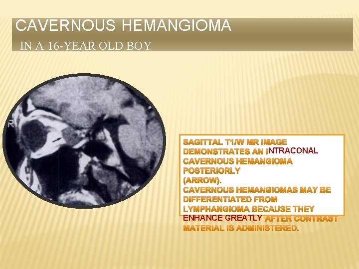 CAVERNOUS HEMANGIOMA IN A 16 -YEAR OLD BOY NTRACONAL ENHANCE GREATLY 