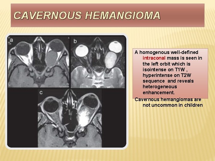 CAVERNOUS HEMANGIOMA A homogenous well-defined intraconal mass is seen in the left orbit which