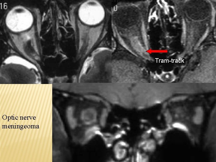 Tram-track Optic nerve meningeoma 