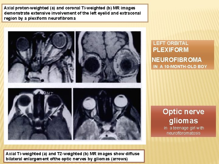 Axial proton-weighted (a) and coronal Ti-weighted (b) MR images demonstrate extensive involvement of the