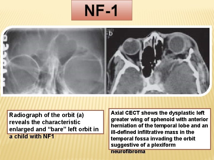 NF-1 Radiograph of the orbit (a) reveals the characteristic enlarged and “bare” left orbit