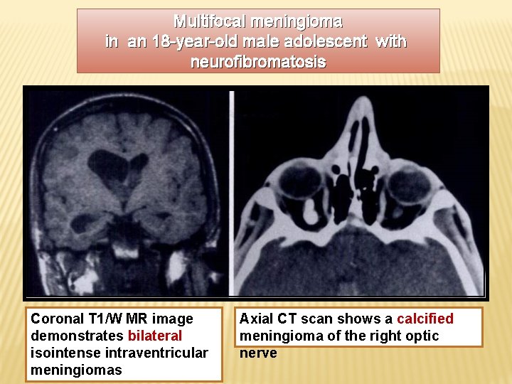 Multifocal meningioma in an 18 -year-old male adolescent with neurofibromatosis Coronal T 1/W MR
