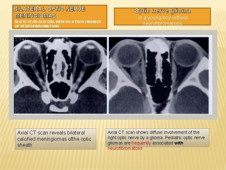 BILATERAL OPTIC NERVE MENINGIOMAS IN A 15 -YEAR-OLD GIRL WITH NO OTHER FINDINGS OF