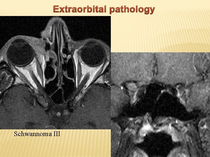 Extraorbital pathology Schwannoma III 