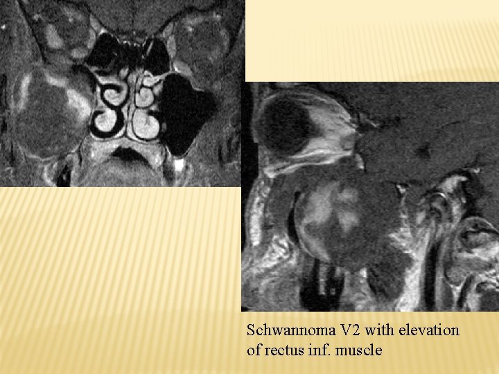 Schwannoma V 2 with elevation of rectus inf. muscle 