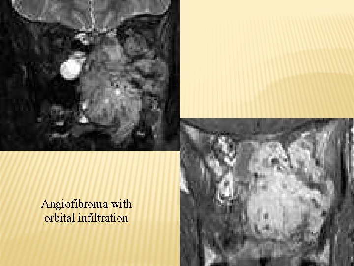 Angiofibroma with orbital infiltration 