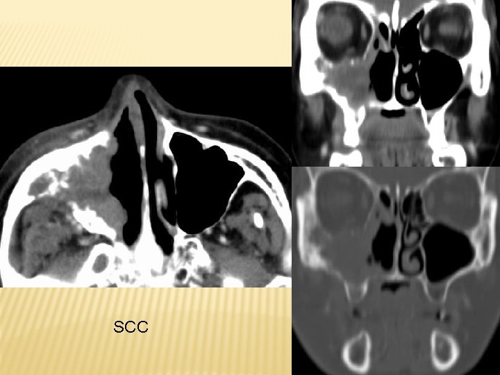 SCC 