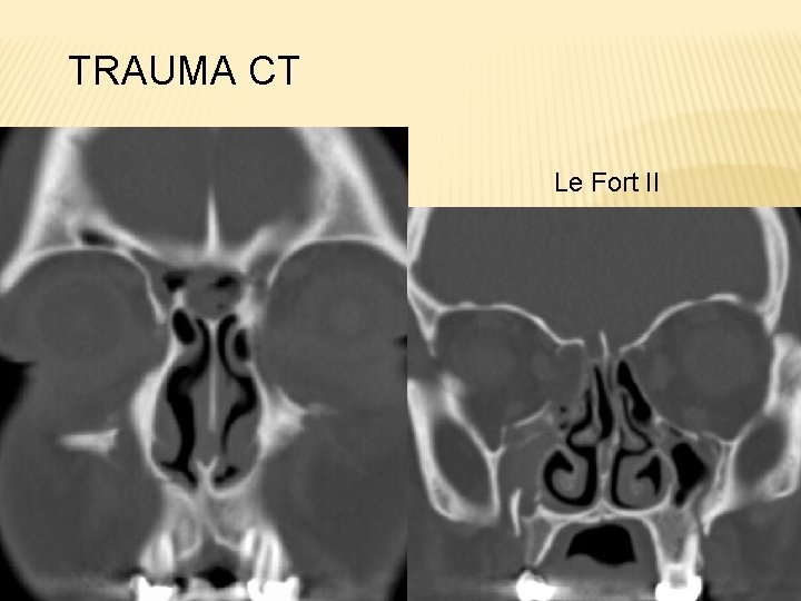 TRAUMA CT Le Fort II 