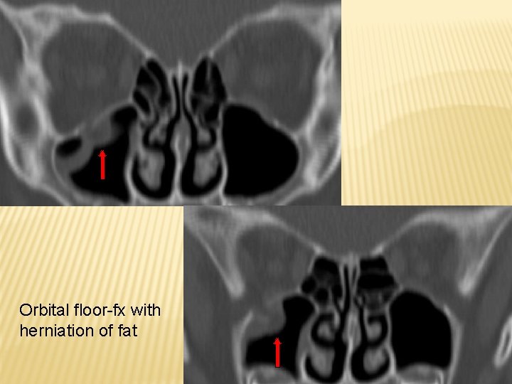Orbital floor-fx with herniation of fat 