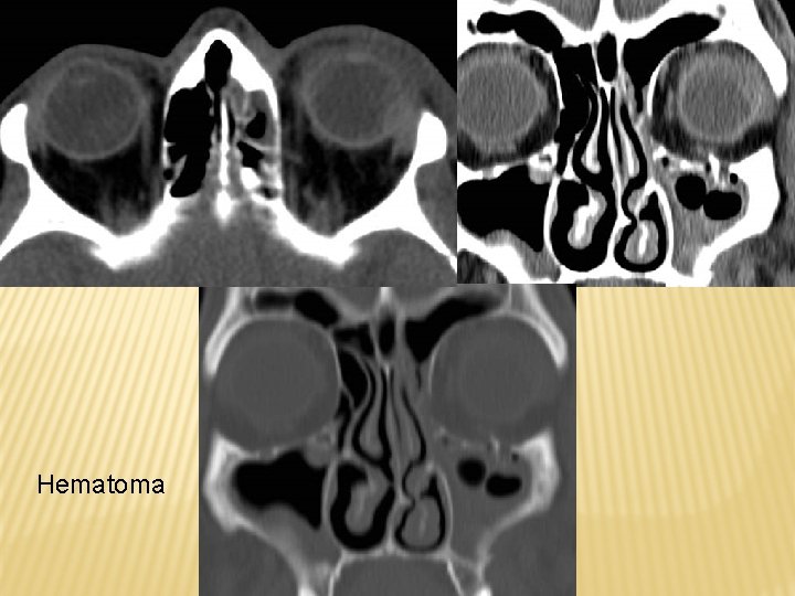 Hematoma 