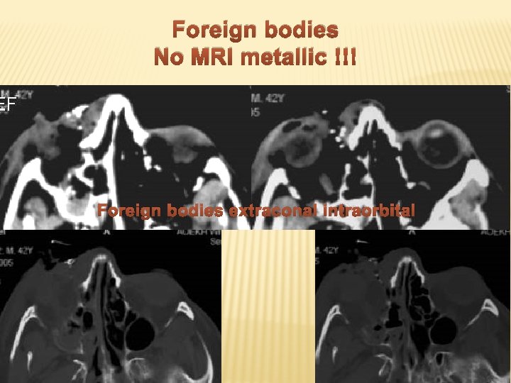 Foreign bodies No MRI metallic !!! Foreign bodies extraconal intraorbital 
