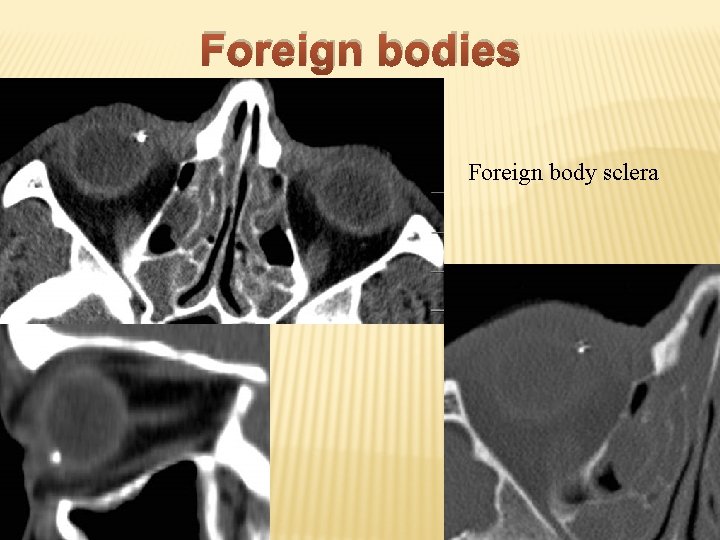 Foreign bodies Foreign body sclera 