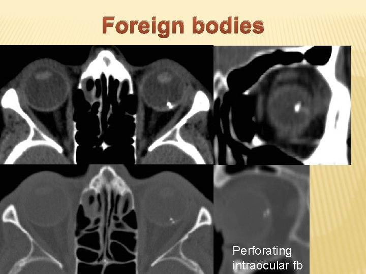 Foreign bodies Perforating intraocular fb 