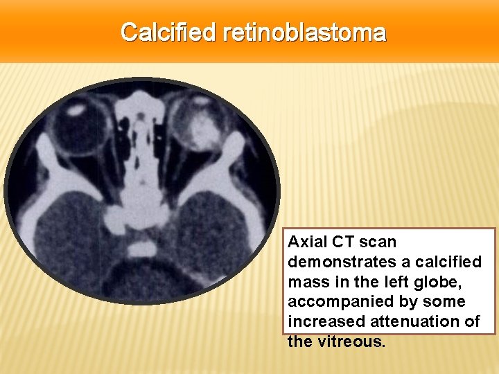 Calcified retinoblastoma Axial CT scan demonstrates a calcified mass in the left globe, accompanied