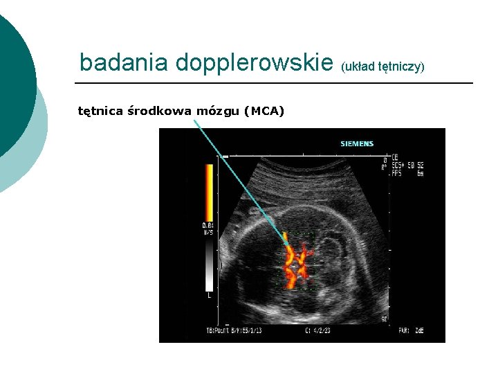 badania dopplerowskie (układ tętniczy) tętnica środkowa mózgu (MCA) 