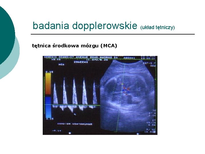 badania dopplerowskie (układ tętniczy) tętnica środkowa mózgu (MCA) 