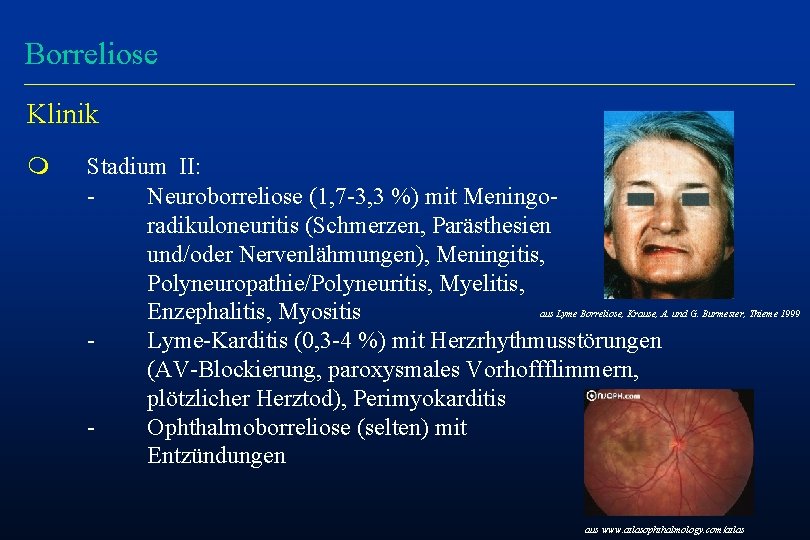 Borreliose Klinik m Stadium II: Neuroborreliose (1, 7 -3, 3 %) mit Meningoradikuloneuritis (Schmerzen,