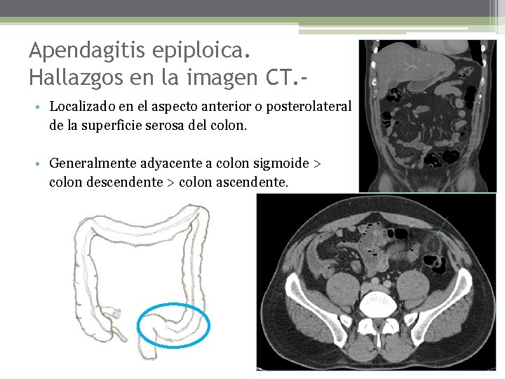 Apendagitis epiploica. Hallazgos en la imagen CT. • Localizado en el aspecto anterior o