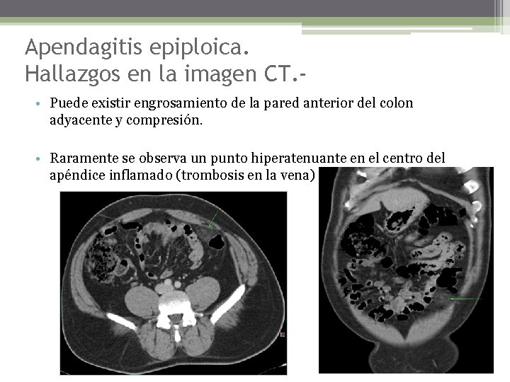 Apendagitis epiploica. Hallazgos en la imagen CT. • Puede existir engrosamiento de la pared