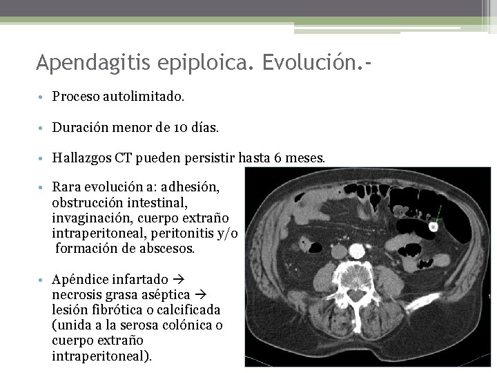 Apendagitis epiploica. Evolución. • Proceso autolimitado. • Duración menor de 10 días. • Hallazgos