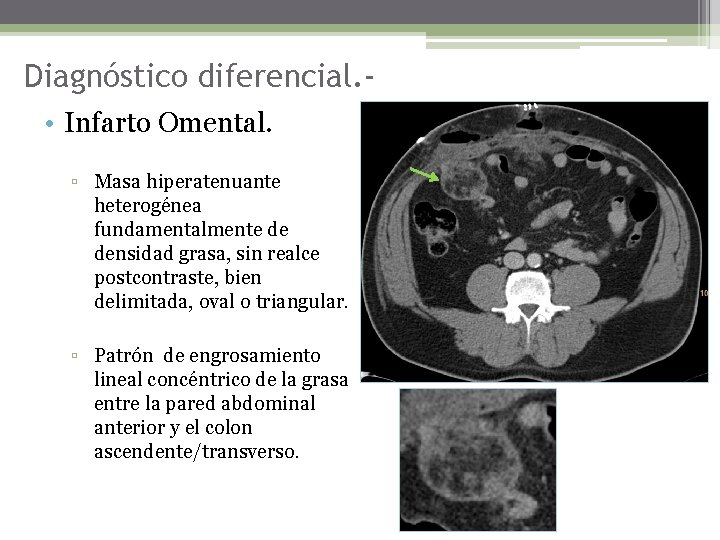 Diagnóstico diferencial. • Infarto Omental. ▫ Masa hiperatenuante heterogénea fundamentalmente de densidad grasa, sin