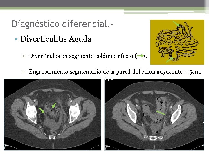 Diagnóstico diferencial. • Diverticulitis Aguda. ▫ Divertículos en segmento colónico afecto ( ). ▫