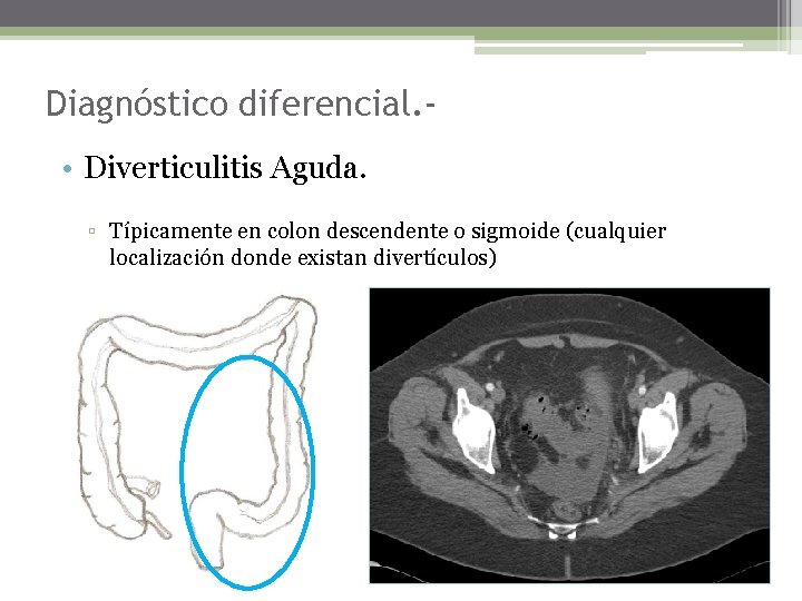 Diagnóstico diferencial. • Diverticulitis Aguda. ▫ Típicamente en colon descendente o sigmoide (cualquier localización