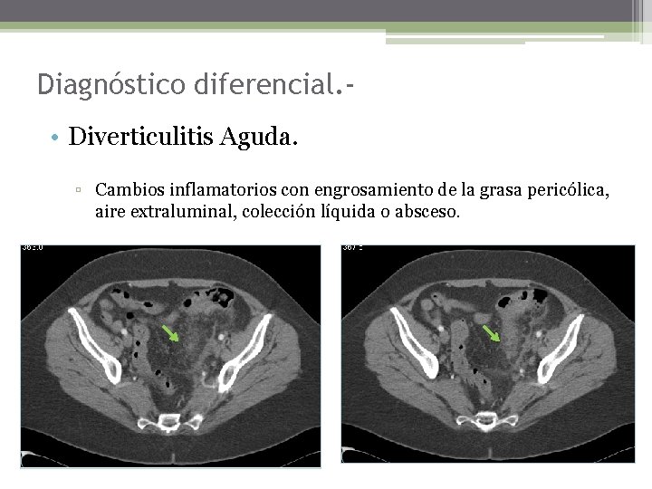 Diagnóstico diferencial. • Diverticulitis Aguda. ▫ Cambios inflamatorios con engrosamiento de la grasa pericólica,