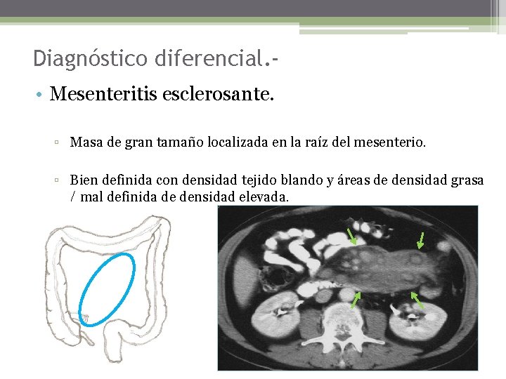 Diagnóstico diferencial. • Mesenteritis esclerosante. ▫ Masa de gran tamaño localizada en la raíz