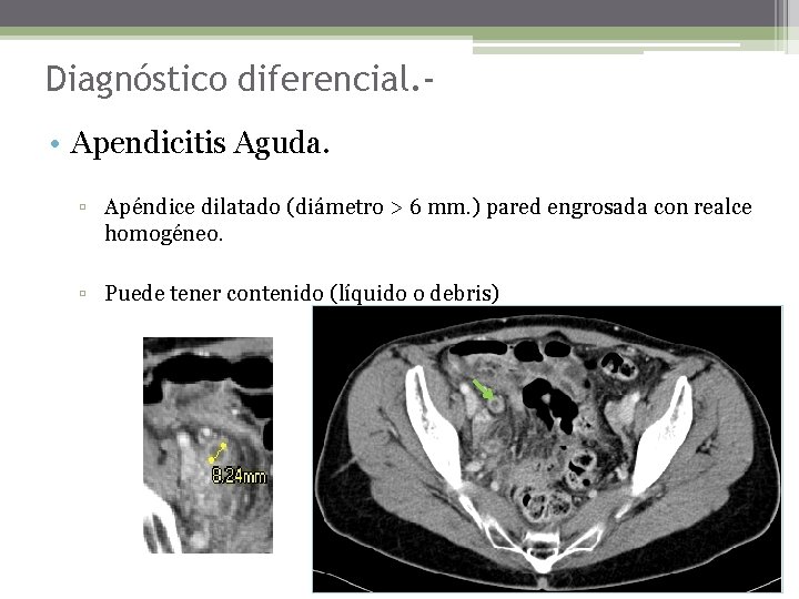 Diagnóstico diferencial. • Apendicitis Aguda. ▫ Apéndice dilatado (diámetro > 6 mm. ) pared