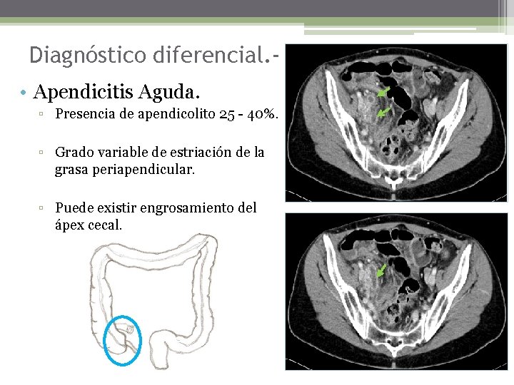 Diagnóstico diferencial. • Apendicitis Aguda. ▫ Presencia de apendicolito 25 - 40%. ▫ Grado