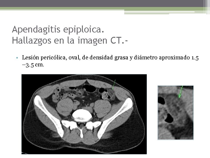 Apendagitis epiploica. Hallazgos en la imagen CT. • Lesión pericólica, oval, de densidad grasa