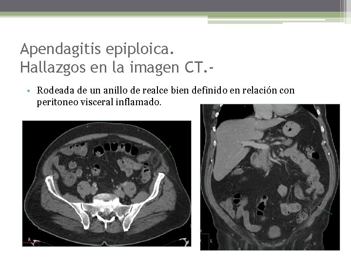 Apendagitis epiploica. Hallazgos en la imagen CT. • Rodeada de un anillo de realce