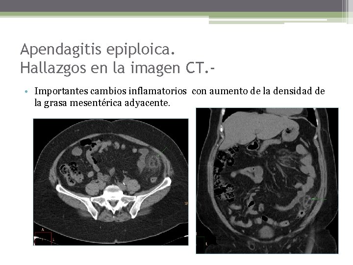 Apendagitis epiploica. Hallazgos en la imagen CT. • Importantes cambios inflamatorios con aumento de