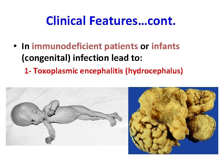 Clinical Features…cont. • In immunodeficient patients or infants (congenital) infection lead to: 1 -