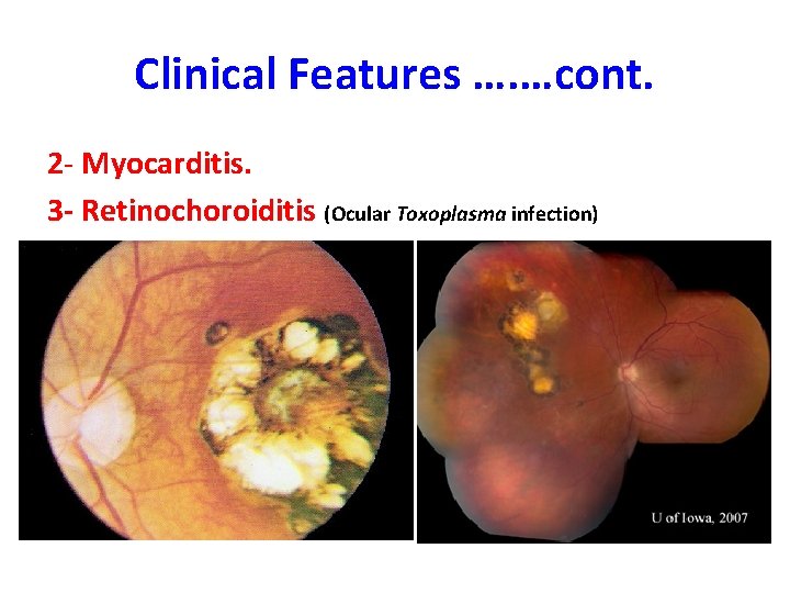 Clinical Features …. …cont. 2 - Myocarditis. 3 - Retinochoroiditis (Ocular Toxoplasma infection) 