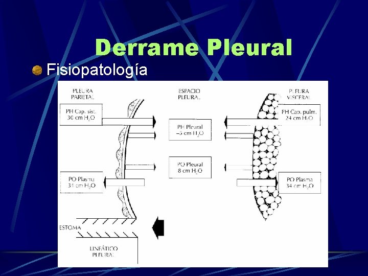 Derrame Pleural Fisiopatología 
