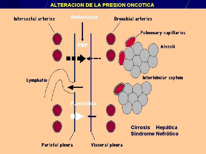 ALTERACION DE LA PRESION ONCOTICA Atelectasia PEP P. oncótica Cirrosis Hepática Síndrome Nefrótico Derrame