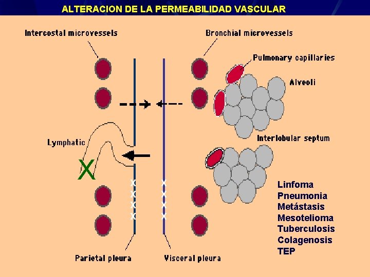 ALTERACION DE LA PERMEABILIDAD VASCULAR X X X X X Derrame Pleural Linfoma Pneumonia