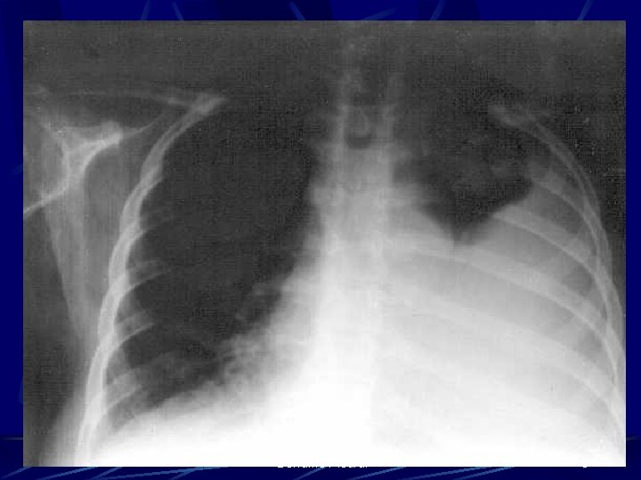 Derrame Pleural 6 
