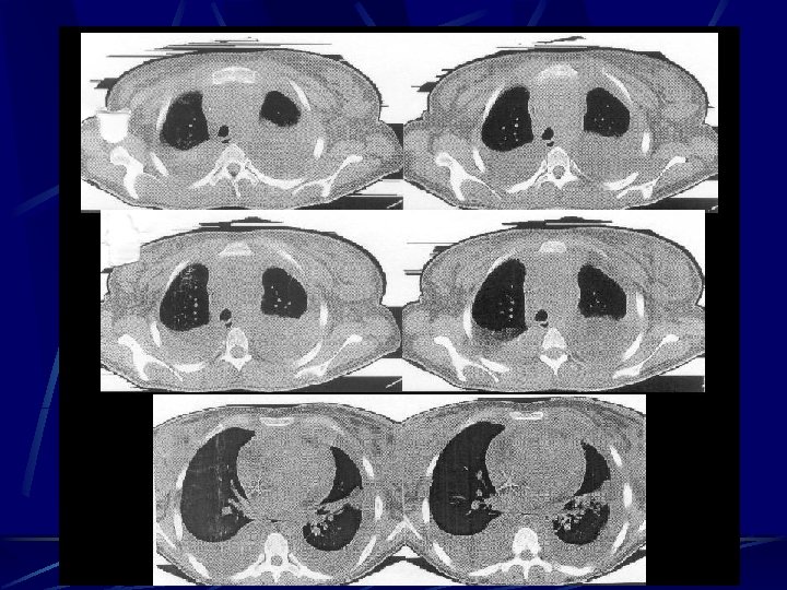 Derrame Pleural 7 