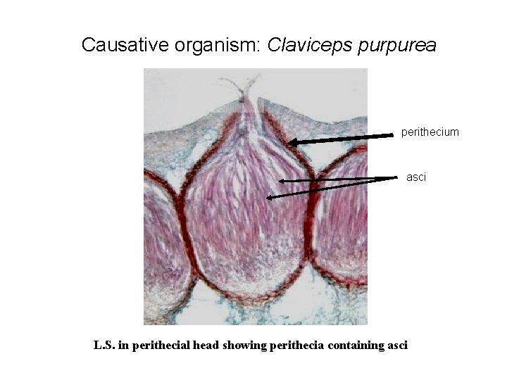 Causative organism: Claviceps purpurea perithecium asci L. S. in perithecial head showing perithecia containing