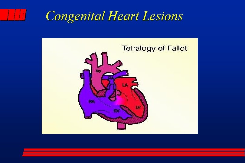 Congenital Heart Lesions 