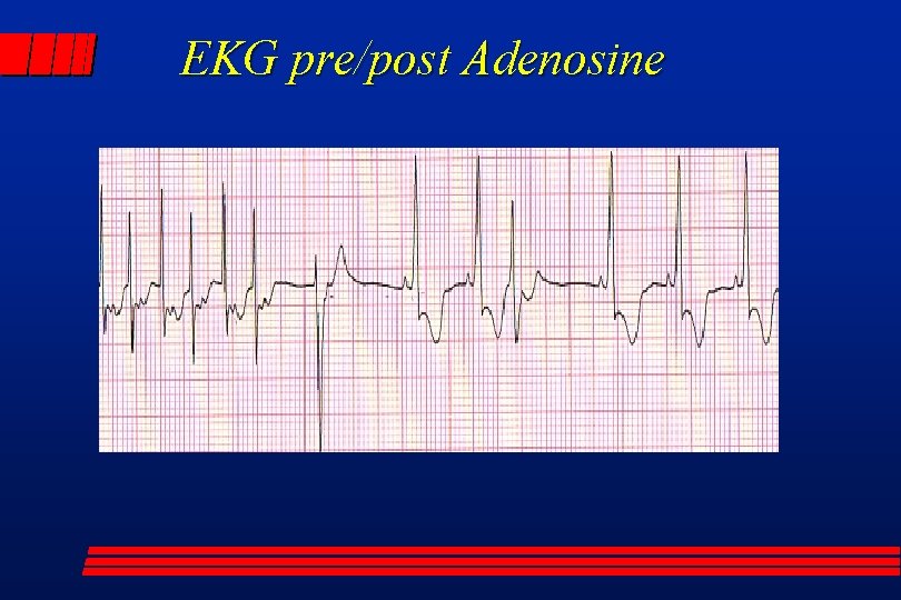 EKG pre/post Adenosine 